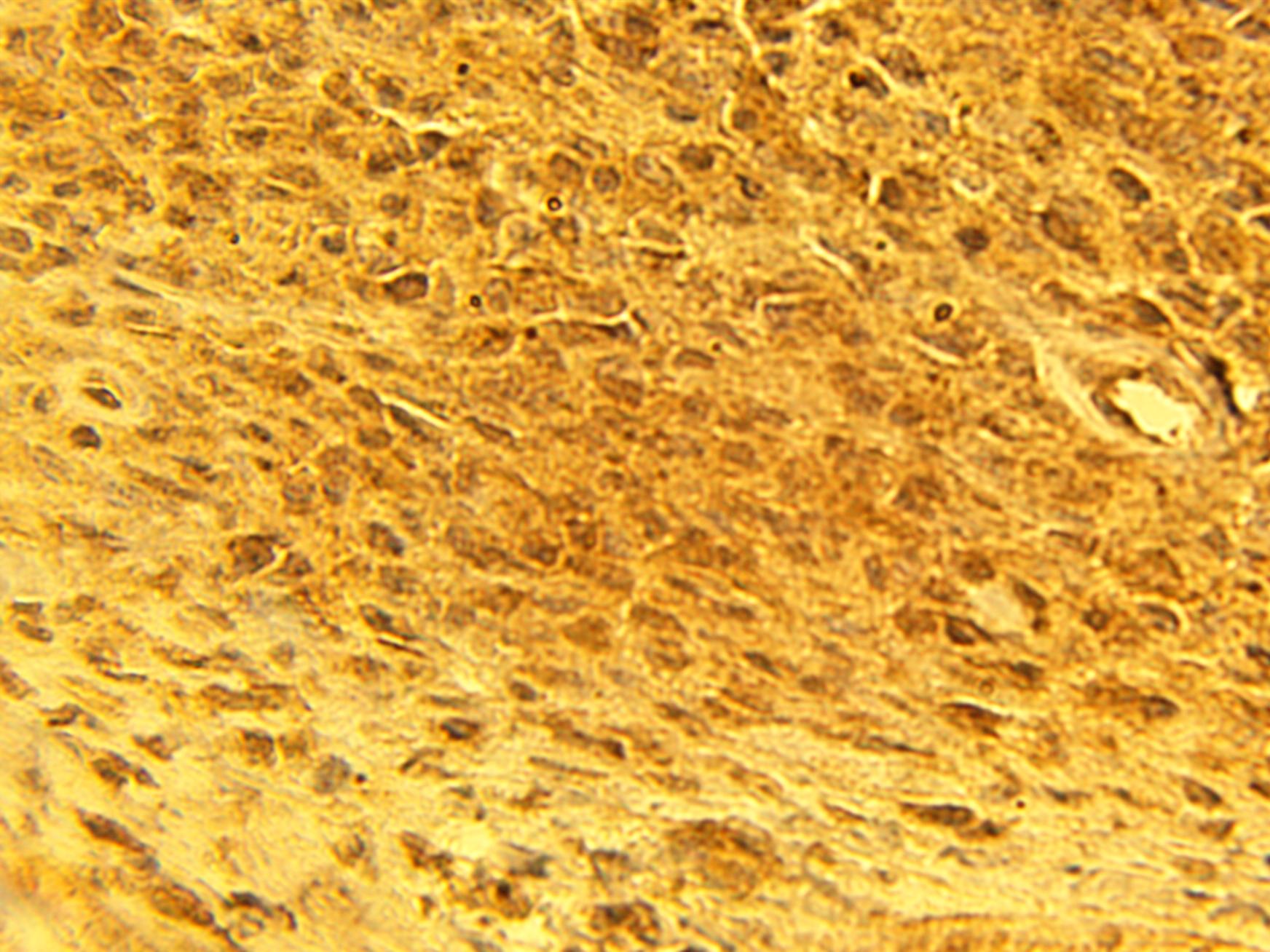Immunohistochemical staining of human melanoma tumor tissue using alpha1G calcium channel antibody (Cat. No. X2715P) at 15 µg/ml.